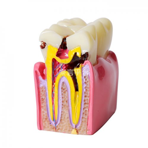 正常牙与龋齿的对照模型   G176